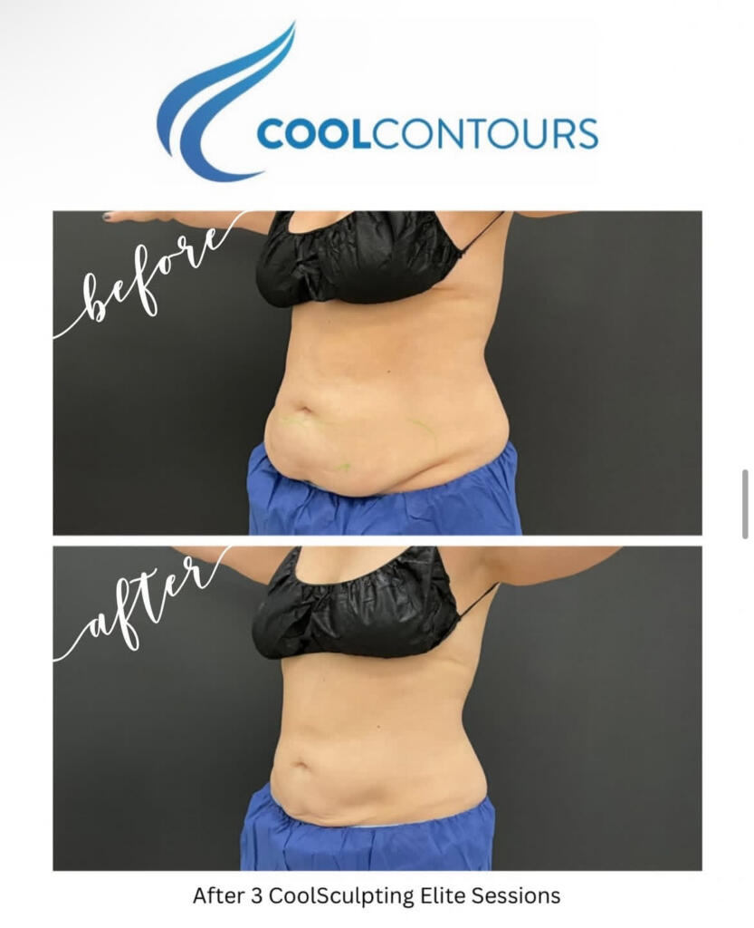 CoolSculpting stomach before and after at Cool Contours