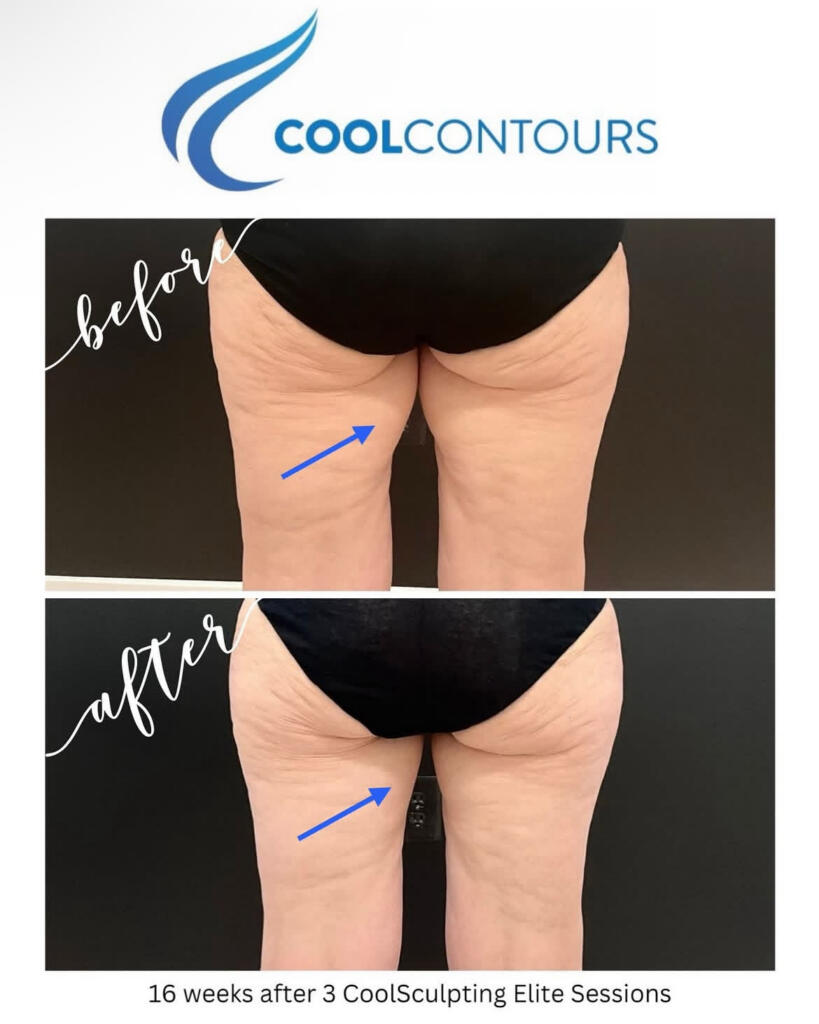 CoolSculpting thighs before and after at Cool Contours