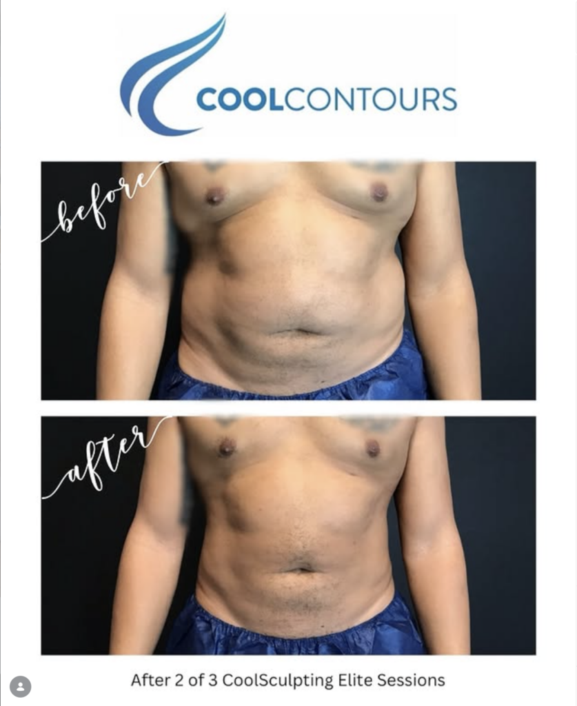 CoolSculpting love handles before and after at Cool Contours