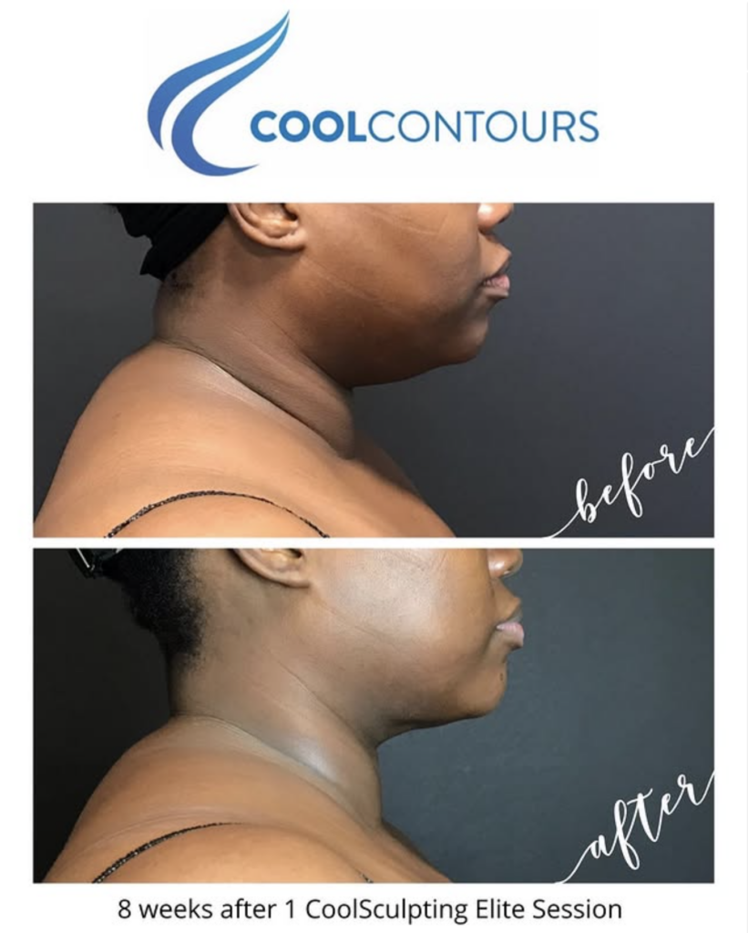 CoolSculpting double chin before and after at Cool Contours