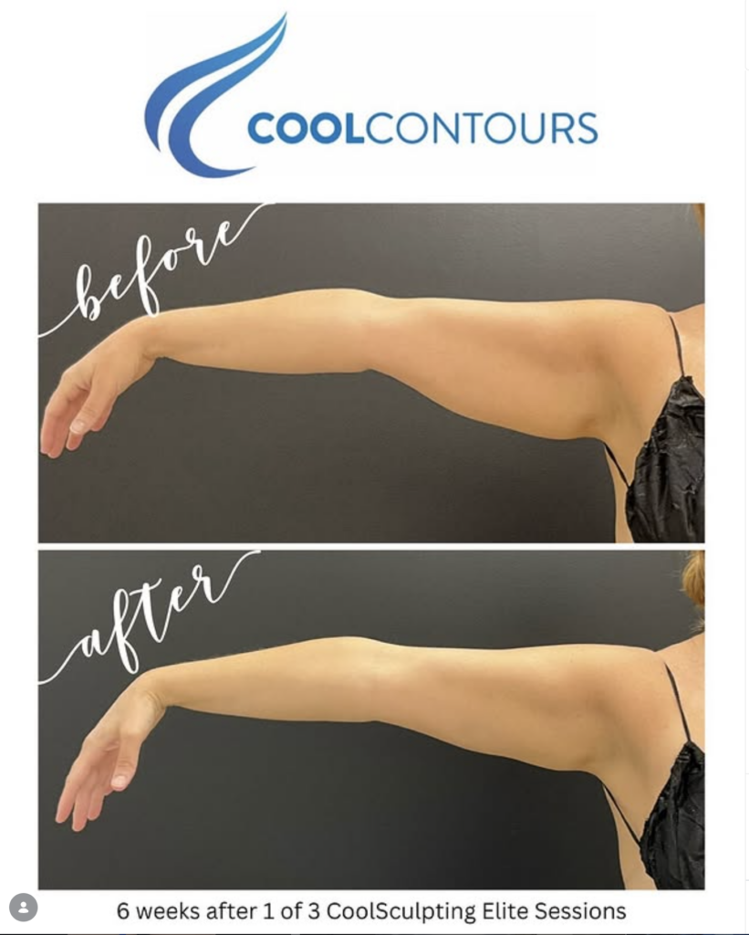 CoolSculpting upper arms before and after at Cool Contours