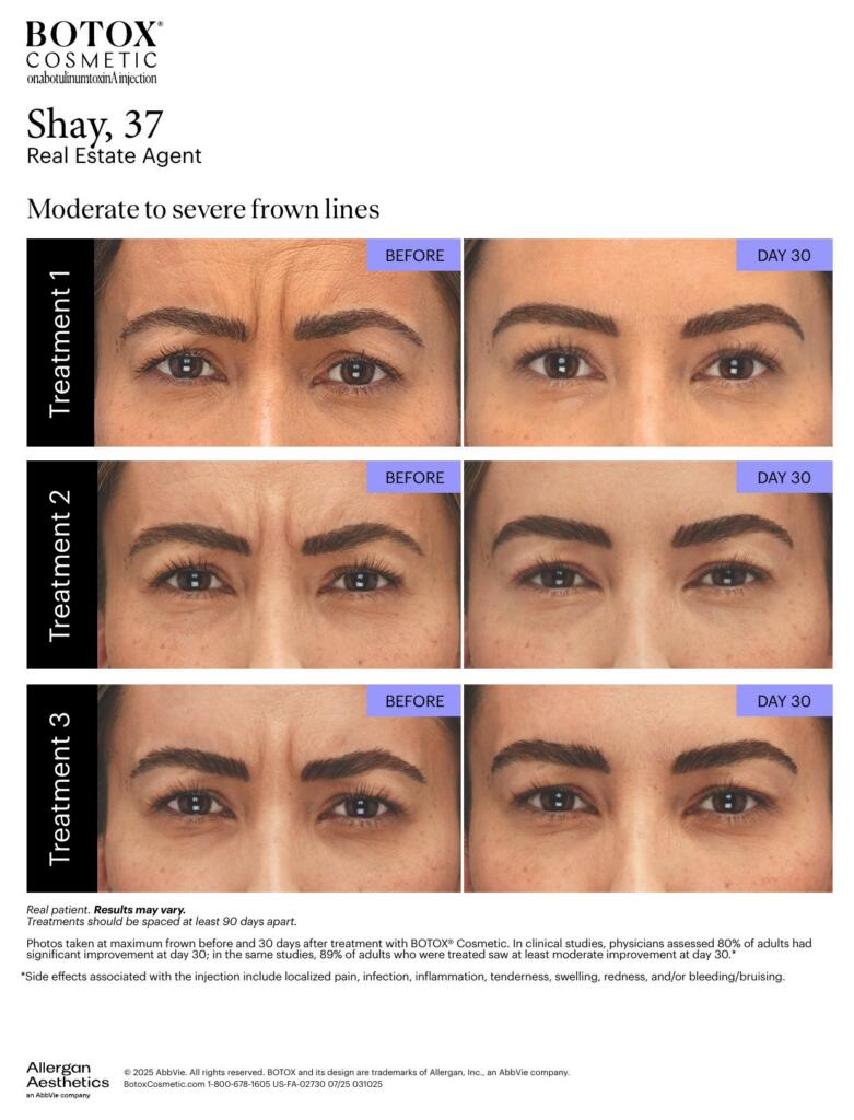 BOTOX Cosmetic frown lines before and after, real patient from Allergan materials