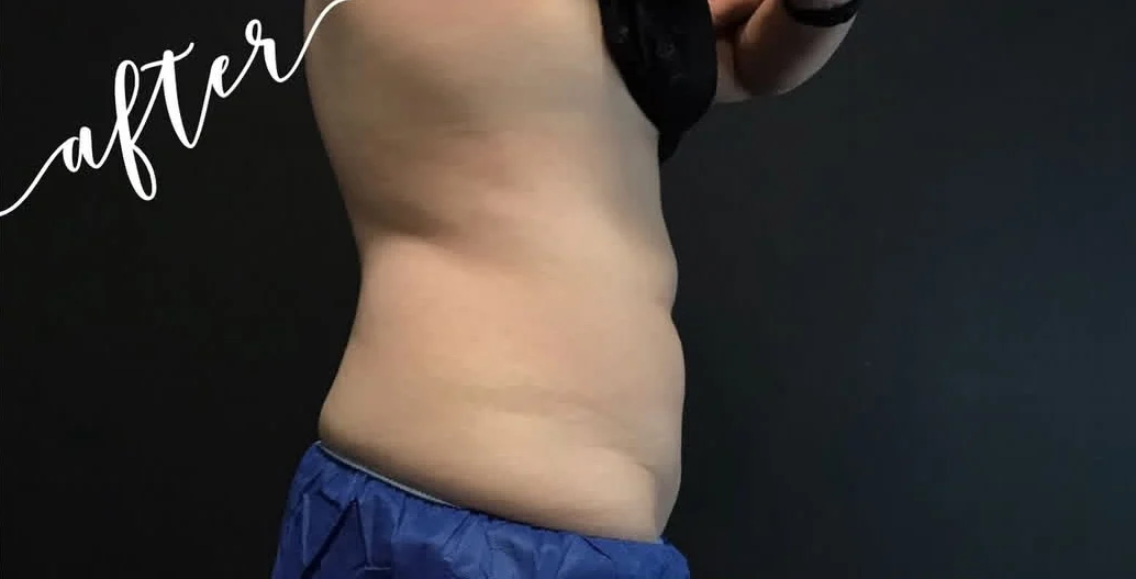 CoolSculpting belly after photo