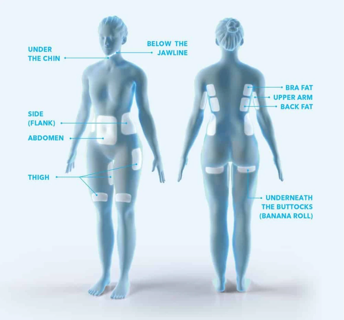 CoolSculpting treatment areas: under the chin, below the jawline, flank, abdomen, thigh, bra fat, upper arm, back fat and underneath the buttocks