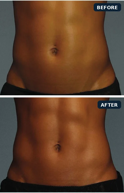 CoolTone abdomen before and after, immediately after 4 treatment visits