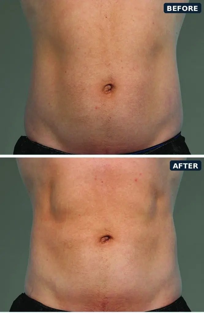 CoolTone abdomen before and after