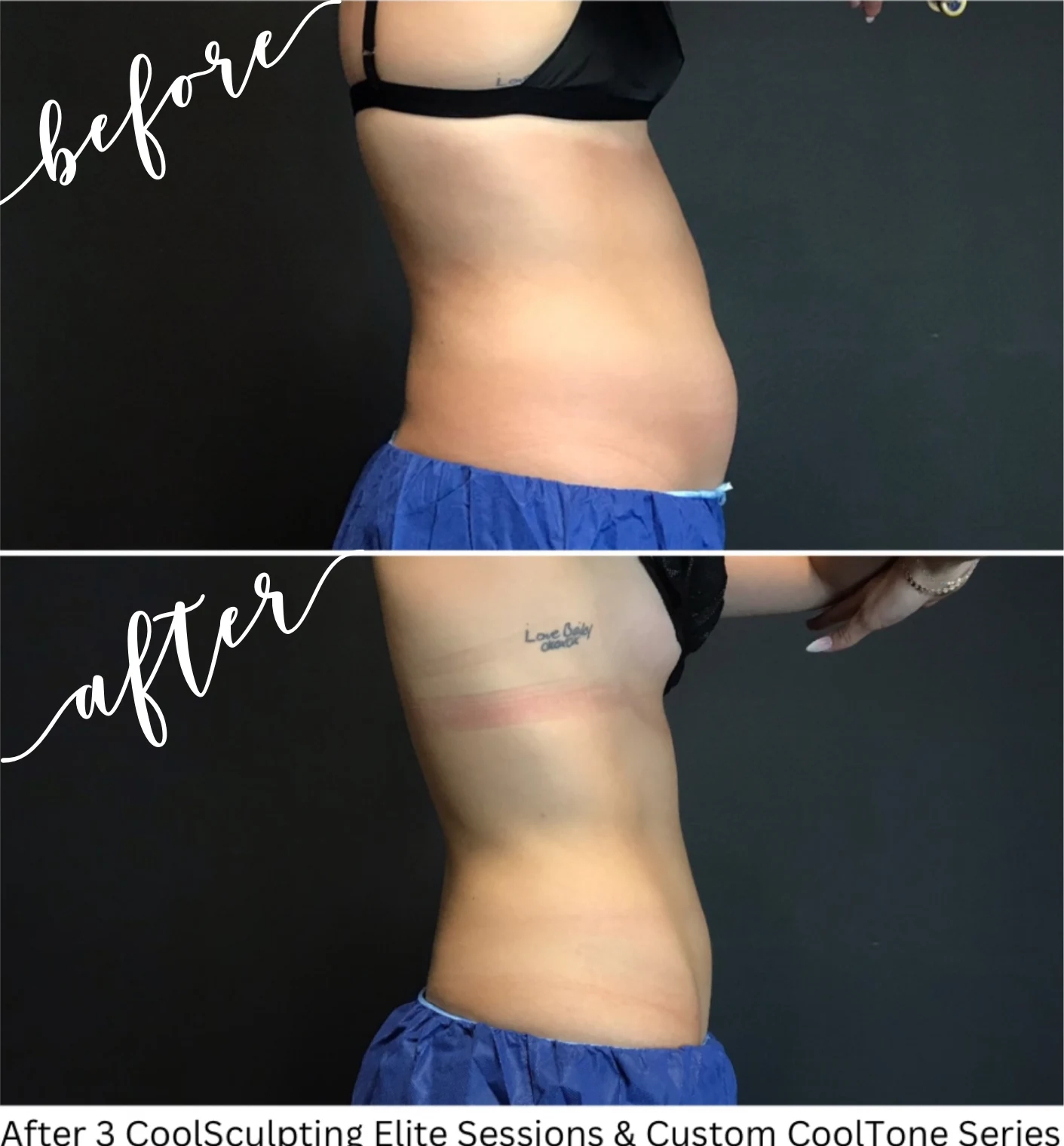 Female client treated with CoolSculpting and CoolTone results side profile abdomen treatment