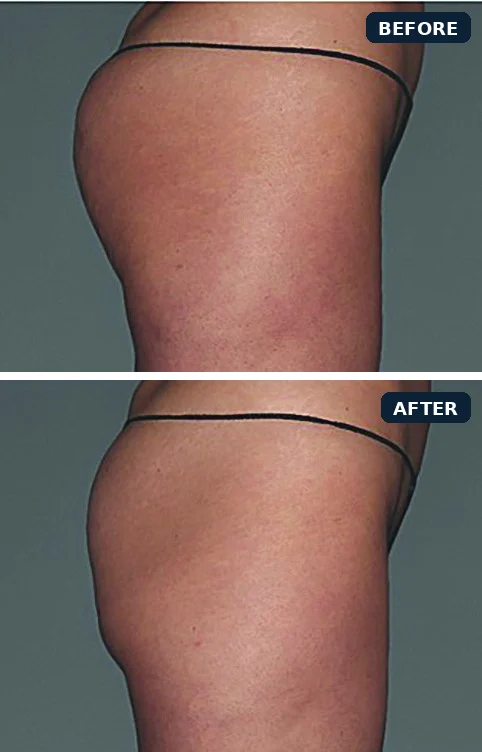 CoolTone glutes before and after, immediately after 4 treatment visits